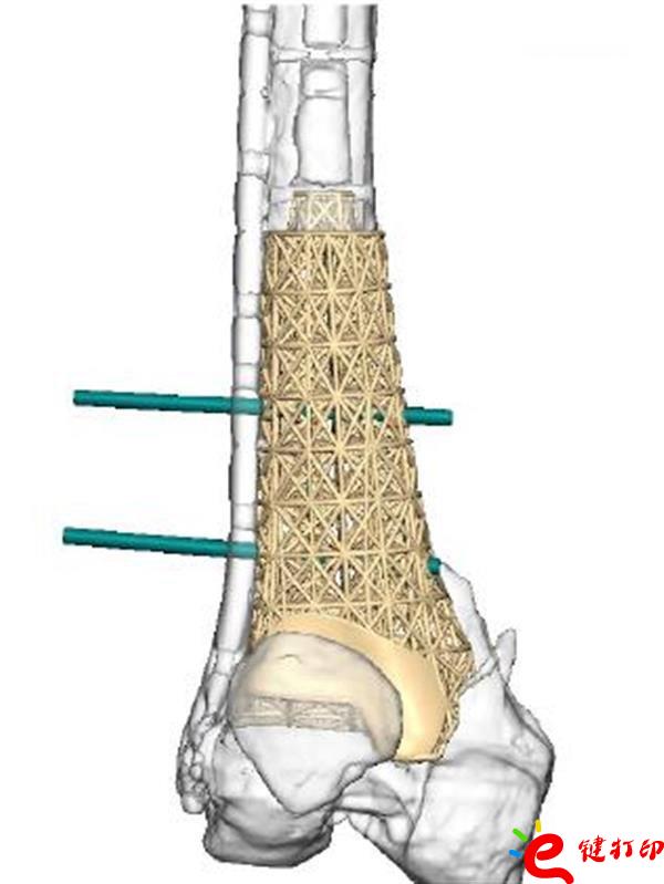 醫療3D打印,3d打印假肢,3d打印假肢,醫療3d打印模型,3D打印植入物,醫療3D打印平臺